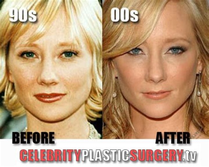 Anne Heche Plastic Surgery Before and After