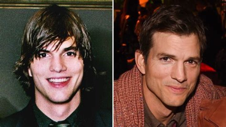 Ashton Kutcher Plastic Surgery Before and After