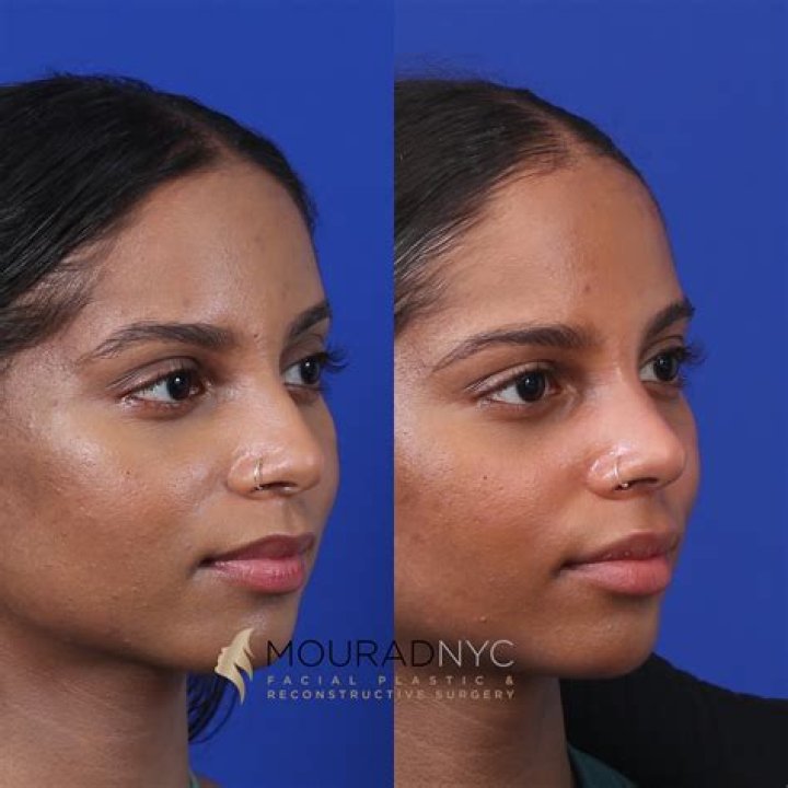 Bernice Burgos Plastic Surgery: Bernice's Open Admission and Efforts for Maintenance!