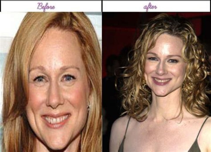 Laura Linney Plastic Surgery Before and After