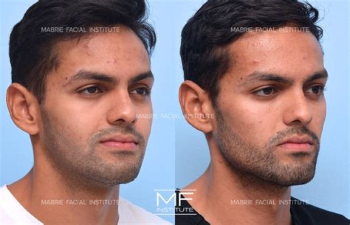 Layton Williams Plastic Surgery: Layton's Altered Face Shape and Well-Defined Jaw!