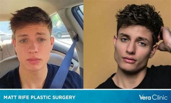 Matt rife before and after photographs: From Natural to Altered